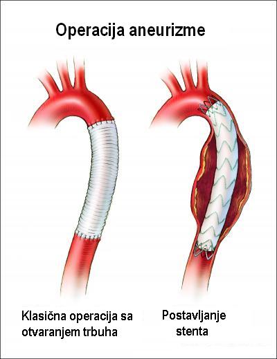 Elongirana aorta sta znaci