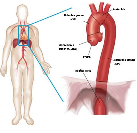 Aneurizma aorte operacija