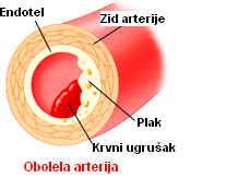 ateroskleroze donjih ekstremiteta i hipertenzije)