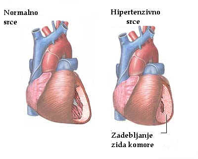 kombinacija hipertenzije i koronarne arterijske bolesti)