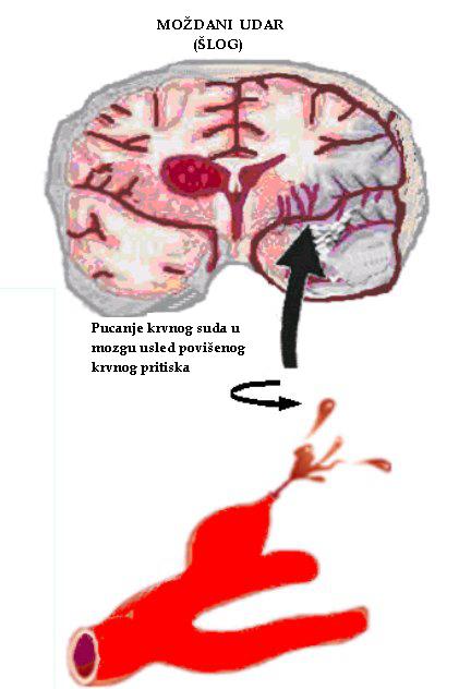 moždani udar, hipertenzija komplikacija