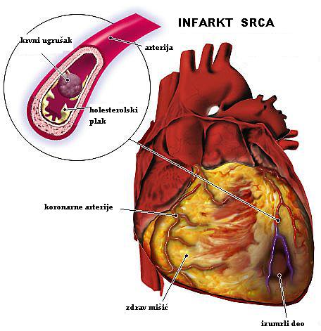 krvni pritisak infarkt hipertenzija vaskularne bolesti