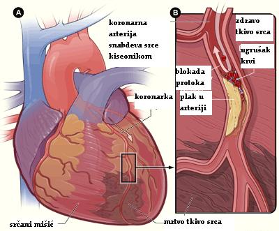 kombinacija hipertenzije i koronarne arterijske bolesti)